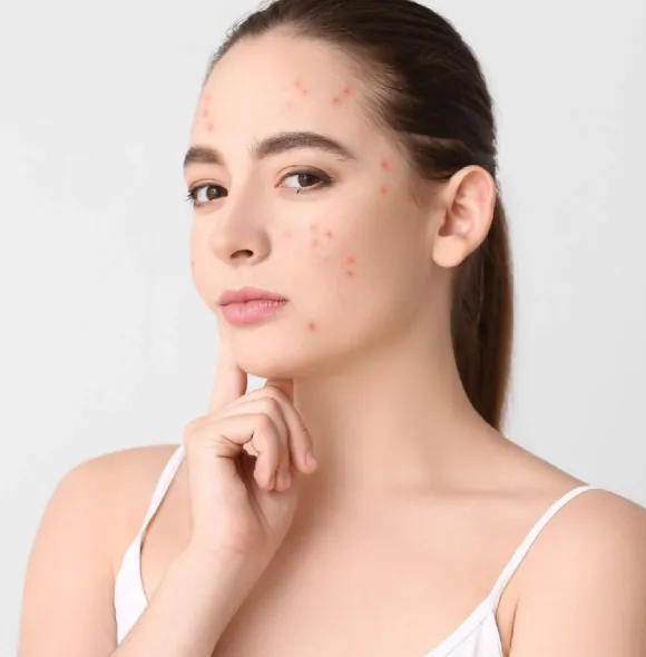 What Adult Acne Really Is